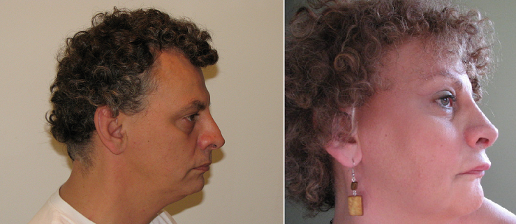 Chirurgie de féminisation faciale de Michelle Blanc, avant et après